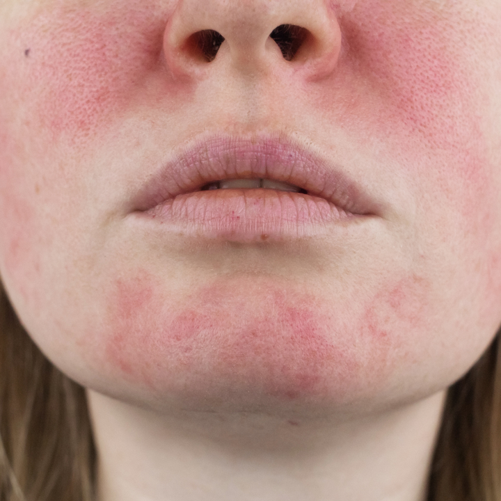 Rosacea Management Guide: Tips and Tricks for Soothing Sensitive Skin